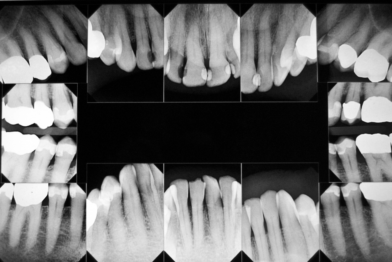 Retroalveolar Total