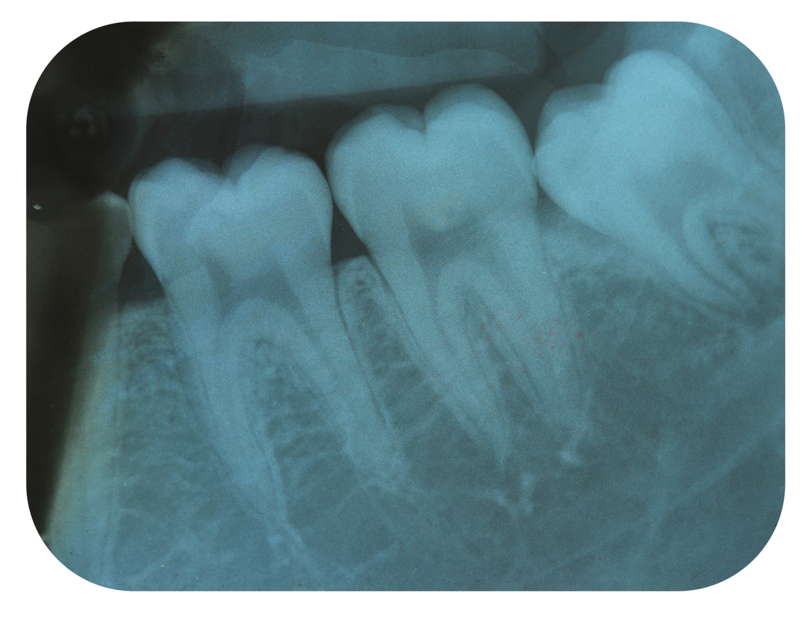 Radiografía Periapical